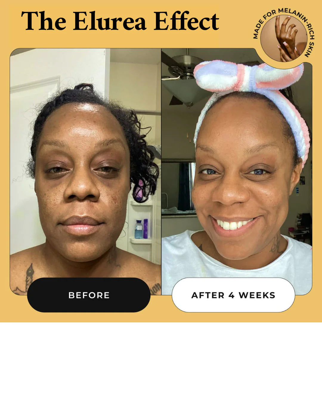 Elurea Micro Infusion System™