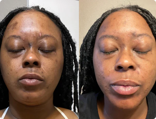 Elurea Micro Infusion System™