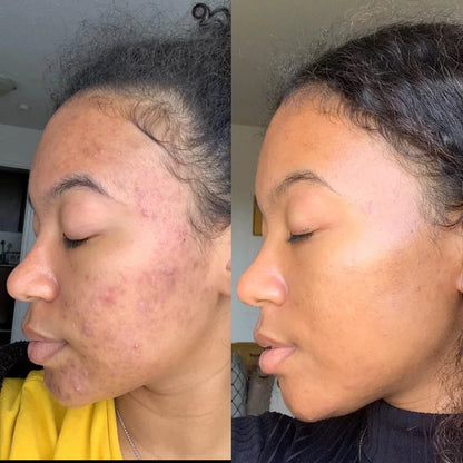 Elurea Micro Infusion Bundle™